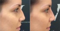 Non Surgical Nose Job at Revere Clinics