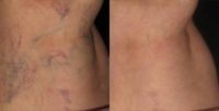 Nonconforming person treated with Sclerotherapy