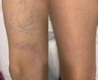 Patient treated with Sclerotherapy
