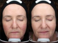 Rosacea treatment including Clearlift treatment