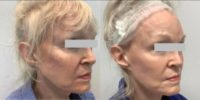 Woman treated with Clear and Brilliant