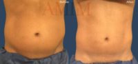 Woman treated with CoolSculpting