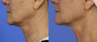 Ultherapy Skin Tightening Treatment on Neck of 45-54 Year Old Woman