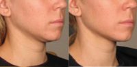 Woman treated with Ultherapy